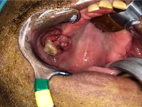 Gum Cancer - Alveolar ridge squamous cell carcinoma