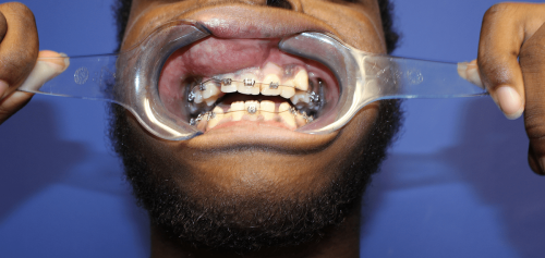 Ameloblastoma - Benign tumor