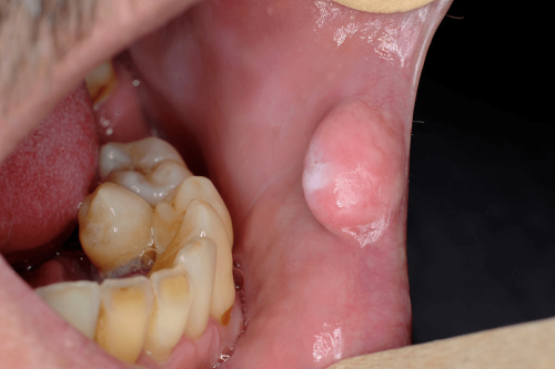 Cheek benign change - Bite Fibroma