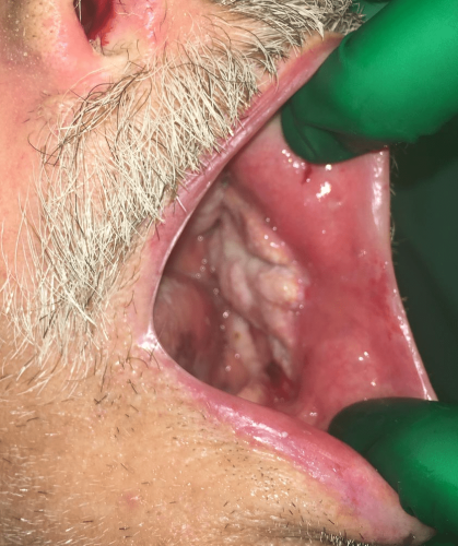 Cheek cancer - Buccal squamous cell carcinoma