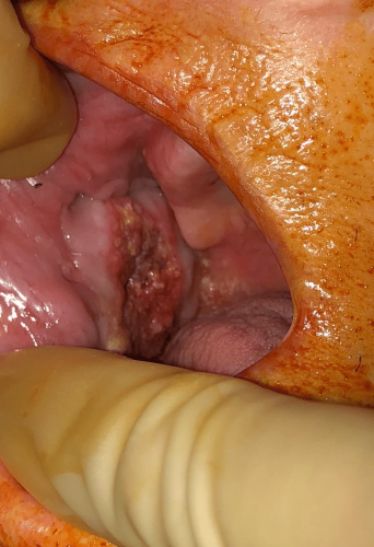 Cheek cancer - Buccal squamous cell carcinoma