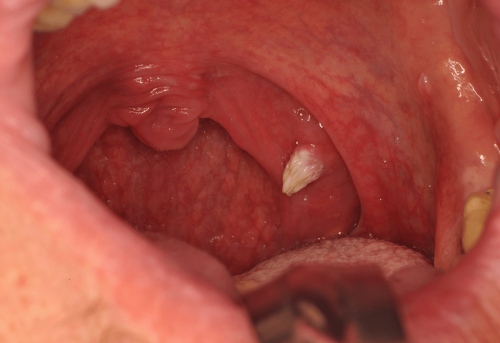 Cutaneous horn -  Benign change