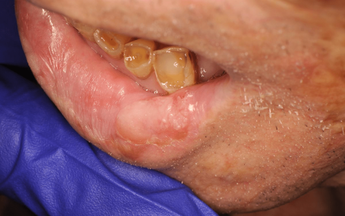 Lip Cancer - Squamous cell carcinoma