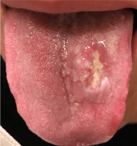 Tongue Cancer - Dorsal squamous cell carcinoma