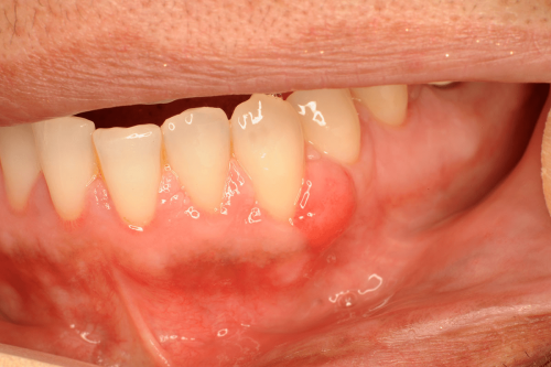 Gum Benign Change - Epulis