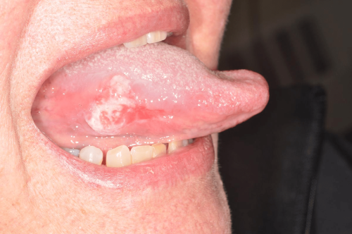 Tongue Precancer - Erythroplakia