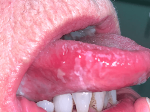 Tongue Precancer - Erythroplakia