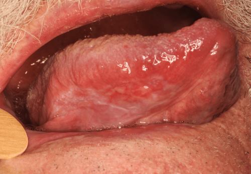 Tongue Precancer - Erythroplakia