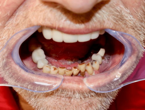 Floor of Mouth Cancer - Squamous cell carcinoma