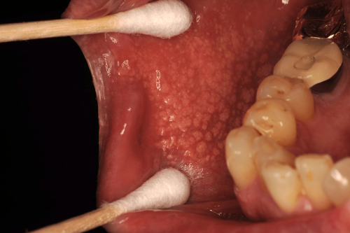 Cheek benign change - Fordyce Spots