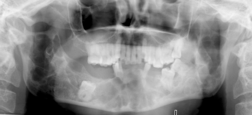 Jaw Benign Tumor - Mandibular giant cell tumor