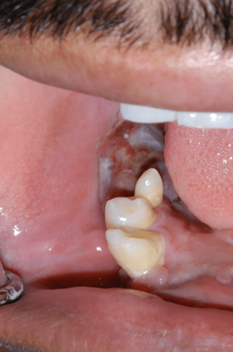 Jaw Benign Tumor - Giant Cell R Mandible