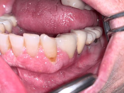 Gum Pre-cancer - Gingival proliferative verrucous leukoplakia