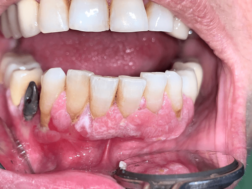 Gum Pre-cancer - Gingival proliferative verrucous leukoplakia