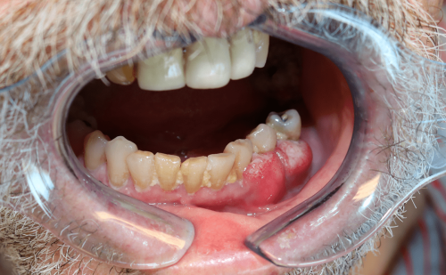 Gum Cancer - Gingival squmaous cell carcinoma