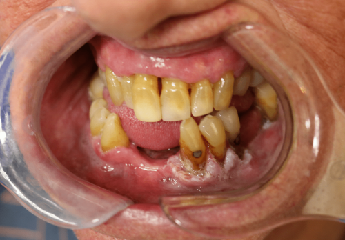 Gum Cancer - Gingival squamous cell carcinoma