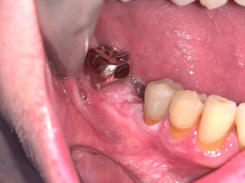 Gum Pre-cancer - Gingival leukoplakia