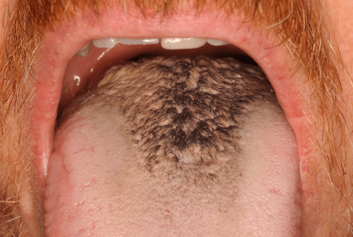 Tongue Benign Change - Hairy tongue