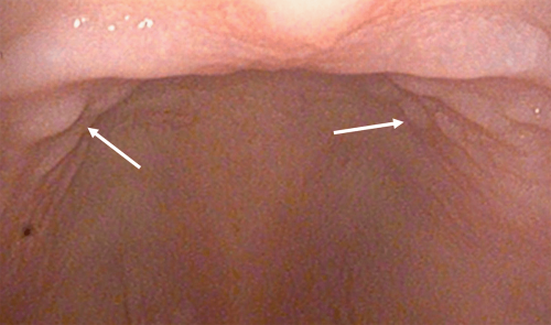 Hard palate ridges - Normal anatomy