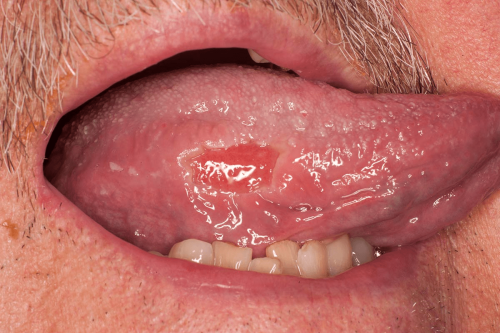 Tongue Benign Change - Herpetic ulcer