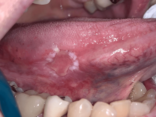 Tongue Precancer - Lateral erythroplakia