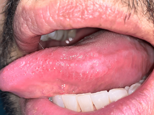 Tongue Precancer -Lateral leukoplakia