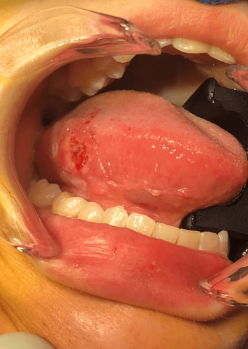 Tongue Cancer - Lateral squamous cell carcinoma