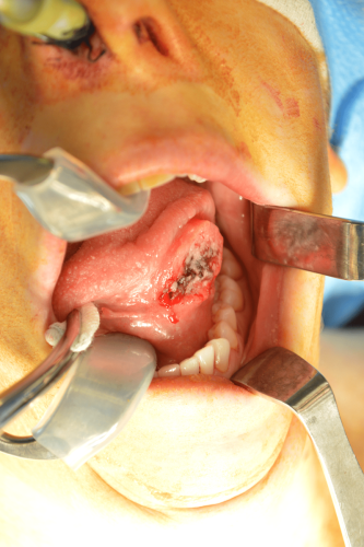 Tongue Cancer - Lateral squamous cell carcinoma