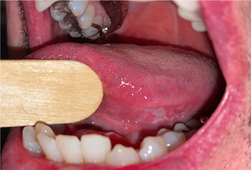 Tongue Cancer - Lateral superficial squamous cell carcinoma