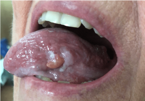 Tongue Cancer - Lateral ulcerative squamous cell carcinoma