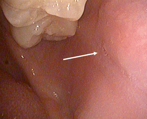 Cheek Normal Anatomy - Left Parotid Duct Papilla