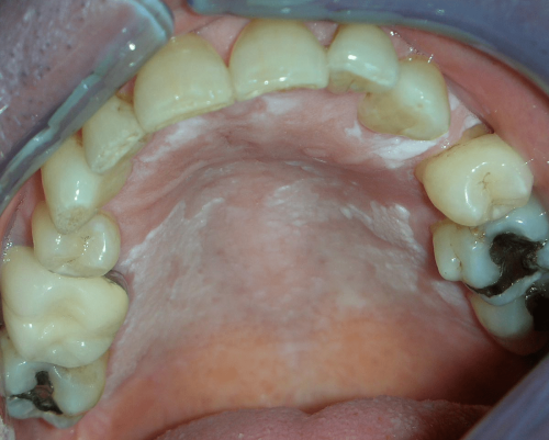 Leukoplakia -  Benign change