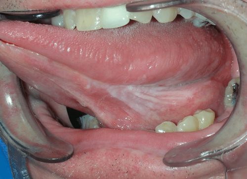 Tongue Precancer - Leukoplakia