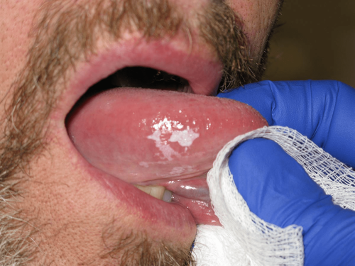 Tongue Precancer - Leukoplakia