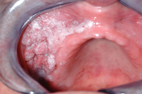 Cheek Pre-cancer - Leukoplakia Verrucous