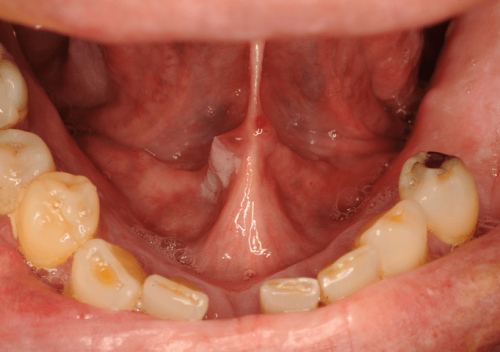 Floor of Mouth Precancer - Leukoplakia