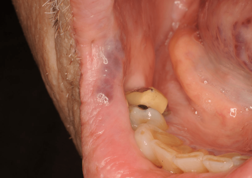 Lip - Benign Change: Vascular Malformation