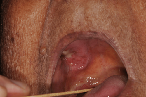 Malignant salivary gland tumor - Cancer