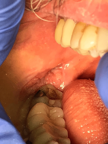 Gum Cancer - Mandibular squamous cell carcinoma