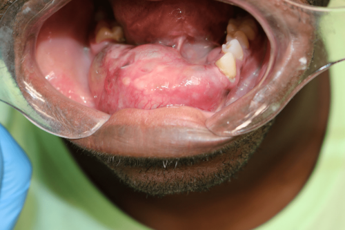 Jaw Benign Tumor - Mandibular Ameloblastoma