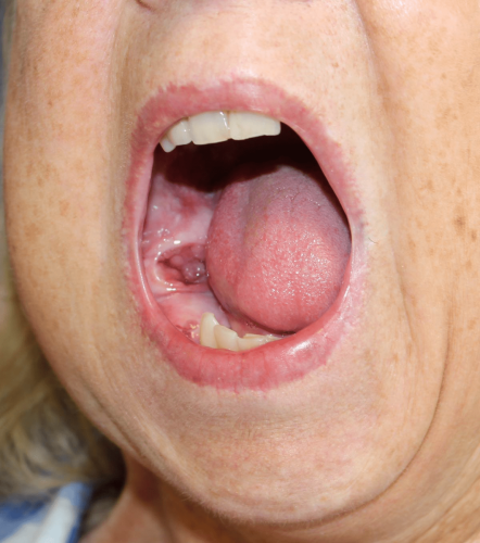 Jaw Benign Tumor - Mandibular Ameloblastoma