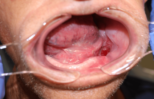 Gum Cancer - Mandibular squamous cell carcinoma