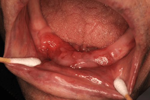 Gum Cancer - Mandibular squamous cell carcinoma