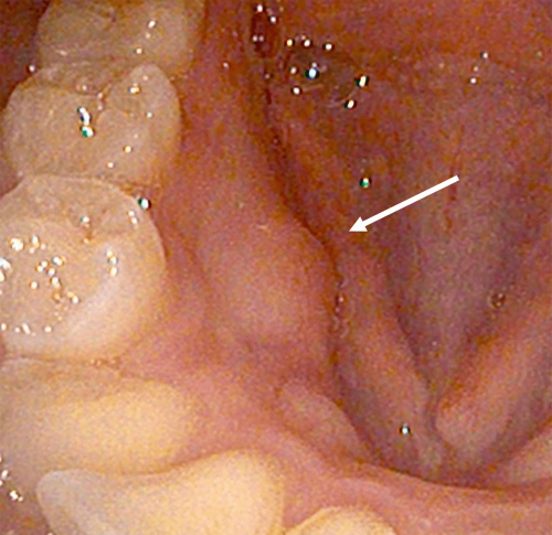 Gum Normal Anatomy - Mandibular torus