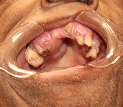 Gum Cancer - Maxillary mucoepidermoid carcinoma