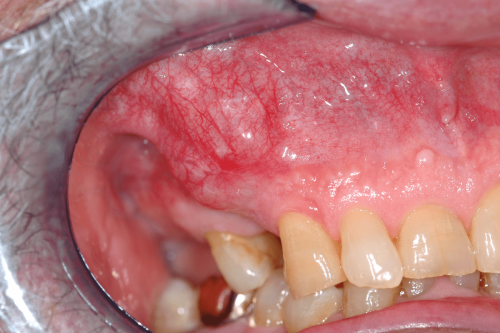 Maxillary lymphoma - Cancer