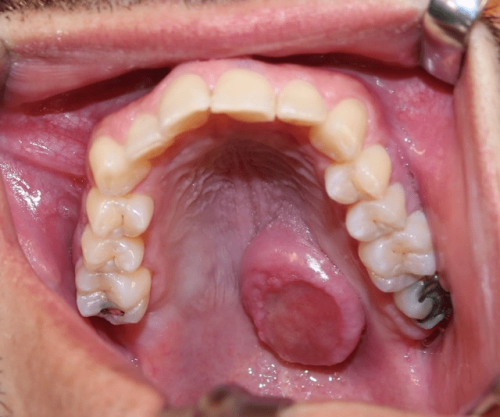 Maxillary pleomorphic adenoma - Benign tumor