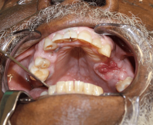 Maxillary squamous cell carcinoma - Cancer