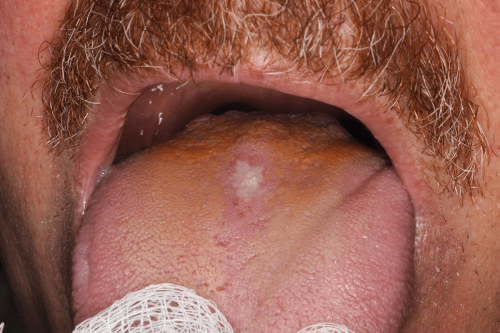 Tongue Benign Change - Median glossitis