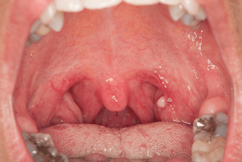 Back of the throat benign change - Mucocele